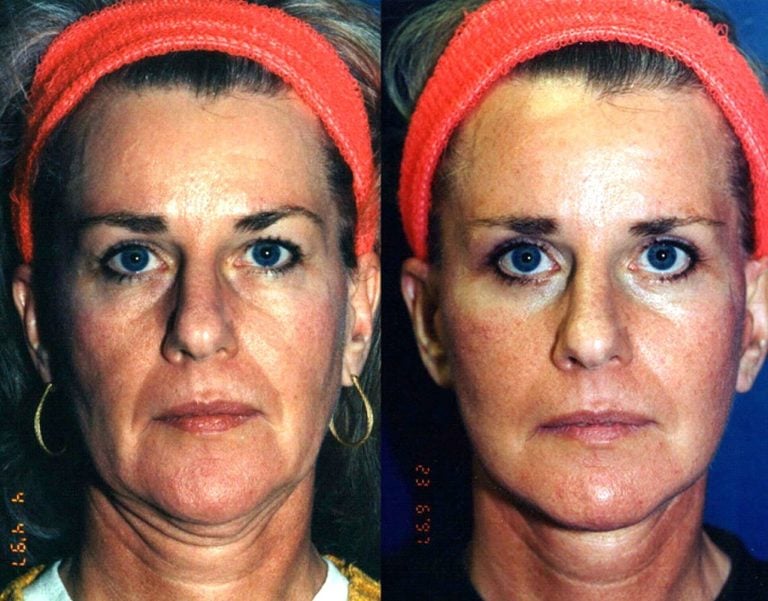 47-year-old-facelift-and-eyelids-six-month-follow-up-front-view