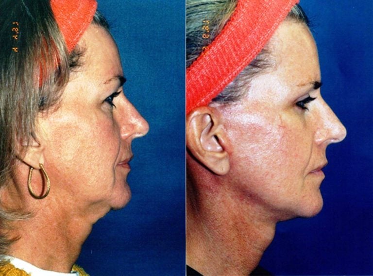 47-year-old-facelift-and-eyelids-six-month-follow-up-side-view
