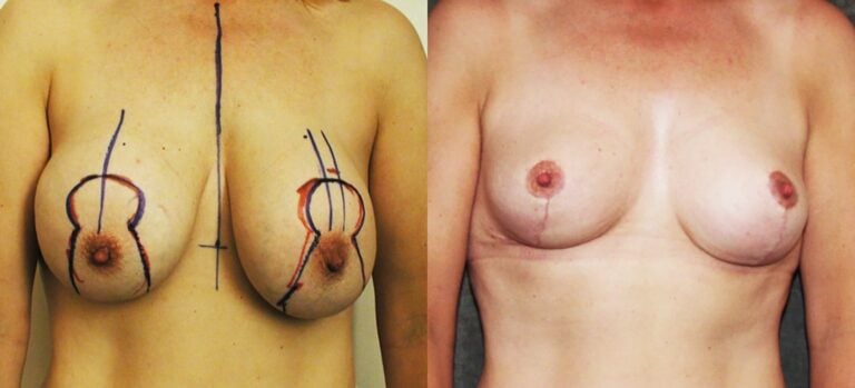 48-year-old with implants and water-fall deformity. Simultaneous Salvage Auto-Augmentation™ with 'J' scar