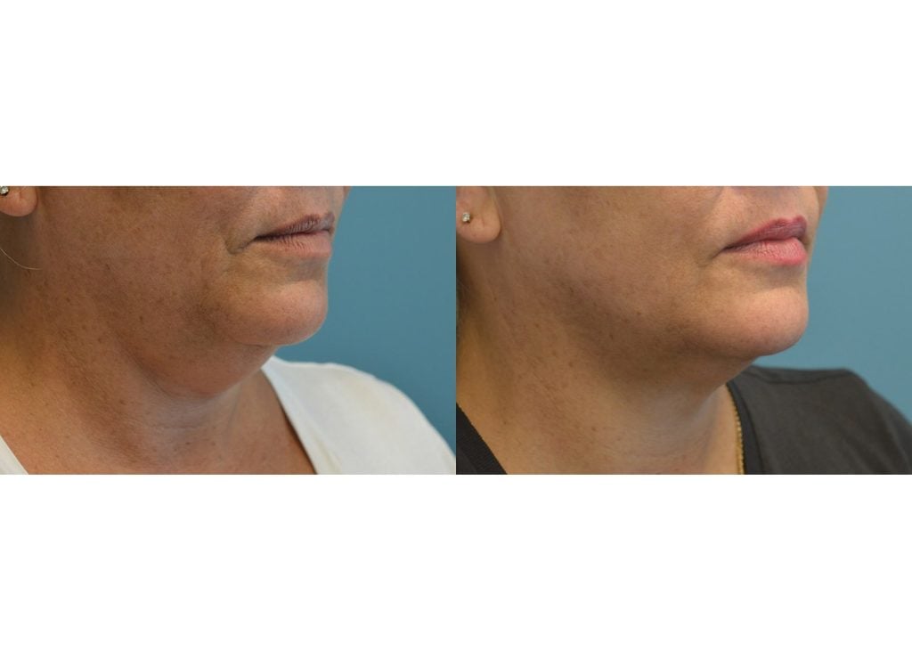 Morpheus8, Facetite Peri-Oral & neck with Liposuction neck, oblique
