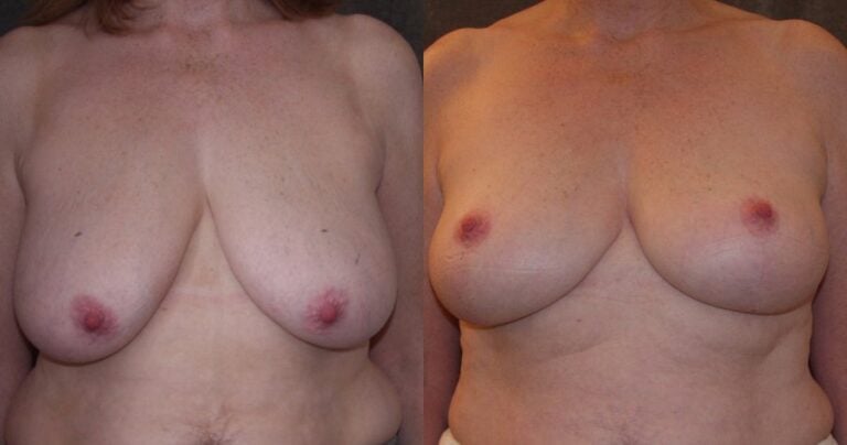 50-year-old-breast-reduction-inferior-pedicle-4-years-front