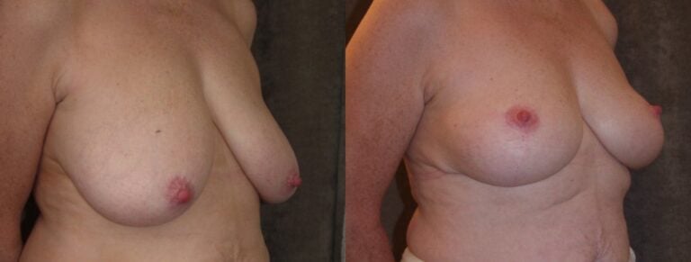50-year-old-breast-reduction-inferior-pedicle-4-years-right-oblique