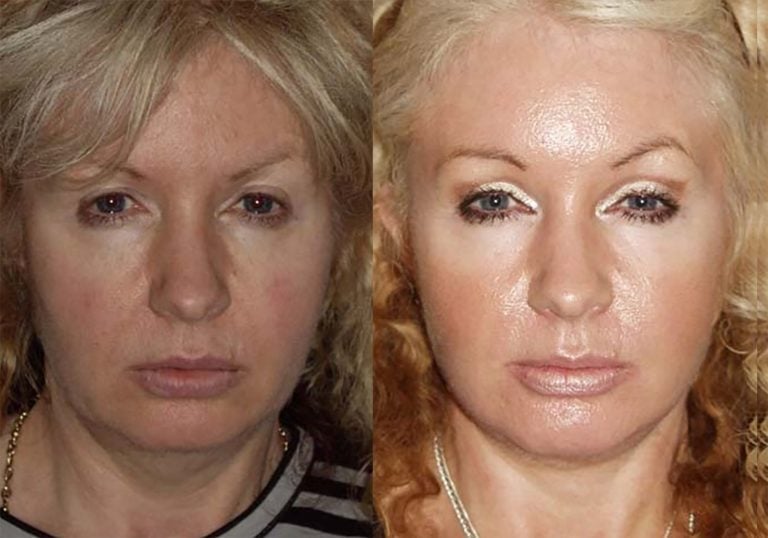 50-year-old-facelift-upper-eyelids-one-year-prior-facelift-10-yrs-before