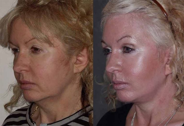 50-year-old-facelift-upper-eyelids-one-year-prior-facelift-10-yrs-before-oblique