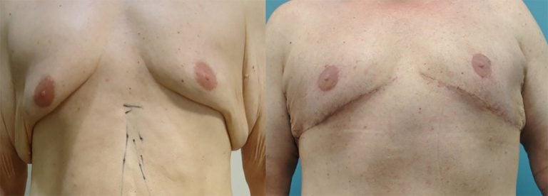 KIRWAN TECHNIQUE for gynecomastia in massive weight loss patient. 51-year-old after 200 lb weight loss. Excision of skin and gland and transposition of nipple on inferior pedicle. No vertical scar. No free-nipple graft. Combined with upper body lift and brachioplasty. 4 months after surgery.