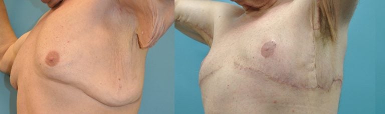 KIRWAN TECHNIQUE for gynecomastia in massive weight loss patient. 51-year-old after 200 lb weight loss. Excision of skin and gland and transposition of nipple on inferior pedicle. No vertical scar. No free-nipple graft. Combined with upper body lift and brachioplasty. 4 months after surgery. Oblique.