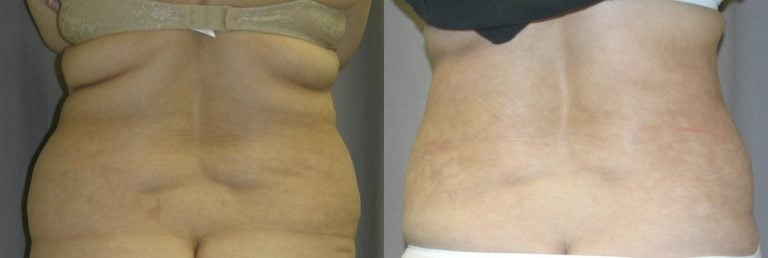 51-year-old-abdominoplasty-liposuction-of-back-1-year-after-surgery-back-view
