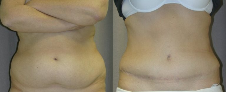 51-year-old-abdominoplasty-liposuction-of-back-1-year-after-surgery-front-view