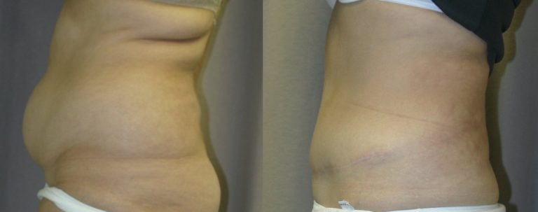 51-year-old-abdominoplasty-liposuction-of-back-1-year-after-surgery-left-side-view