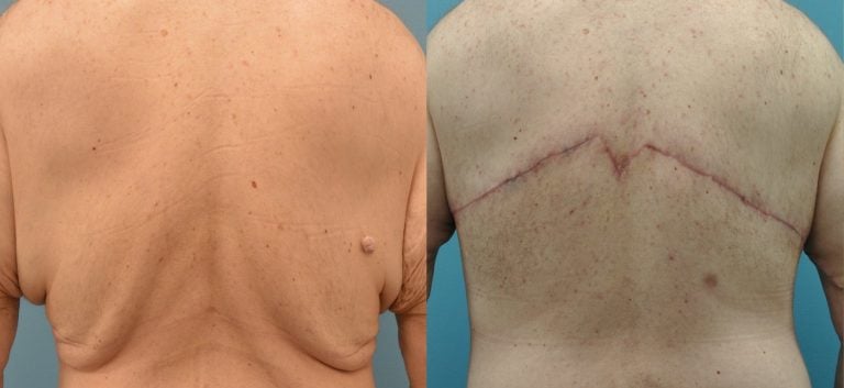 51 year old male after upper body lift, 3 months