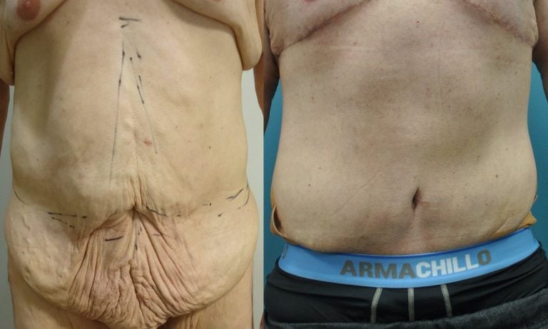 51-year-old-male-lower-body-lift-months-after-surgery-front-view
