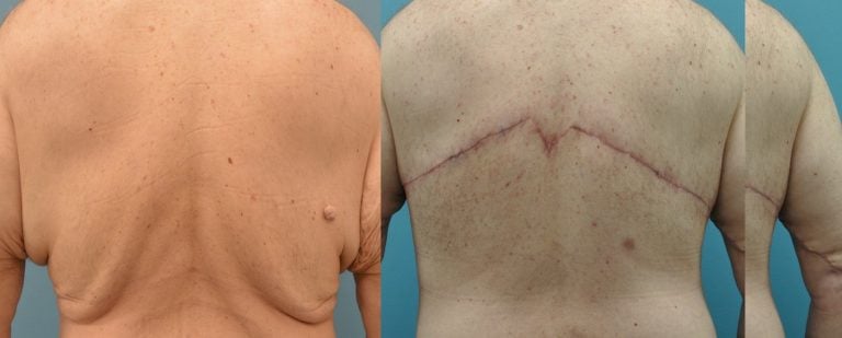 51-year-old-male-upper-body-lift-3-months-after-surgery-back-view