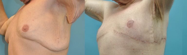 51-year-old-male-upper-body-lift-gynecomastia-excision-3-months-after-surgery-oblique-view