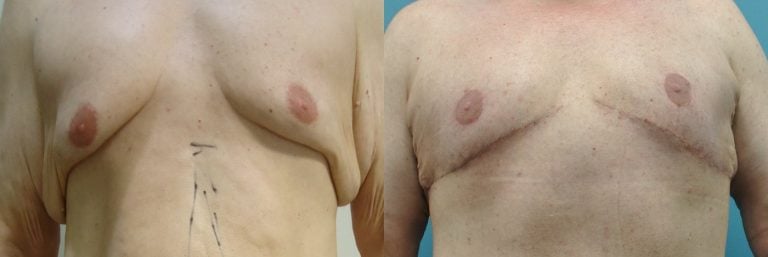 51-year-old-male-upper-body-lift-gynecomastia-excision-4-months-after-surgery-front-view
