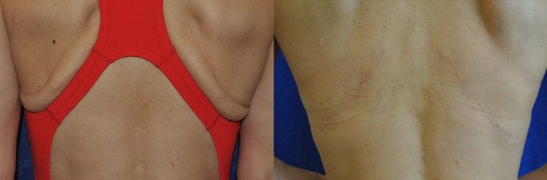 52-year-old female after flank lift 19 months