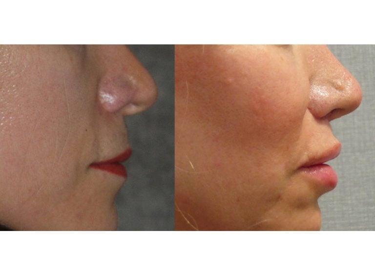 52 year old upper lip shortening 8 months after surgery right sideview