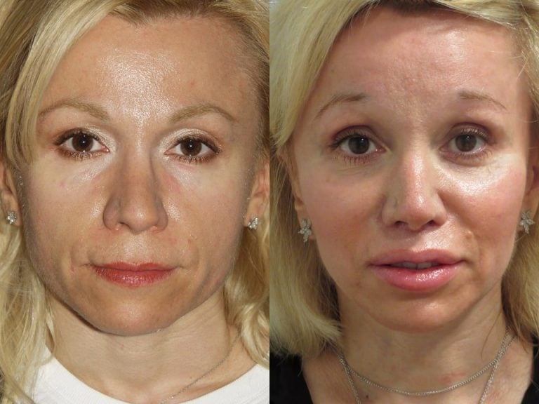 52-year old upper lip shortening, chin implant, fat injection lips