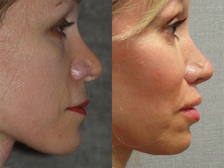 54 year-old patient, lip lift and fat injections to lips - 5