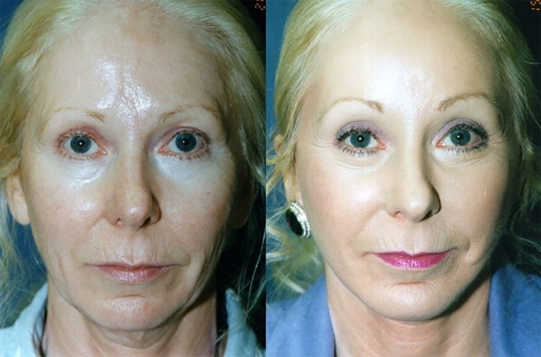 54-year-old-facelift-upper-lower-eyelids-perioral-peel-chin-implant-one-year