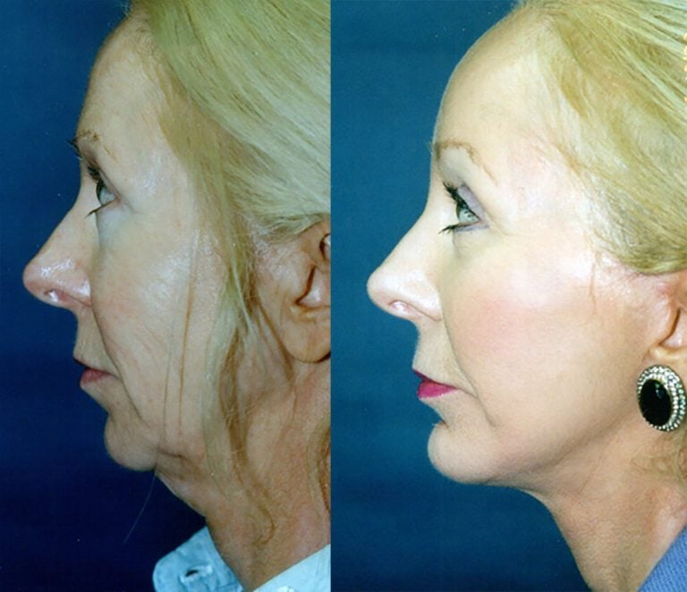 54-year-old-facelift-upper-lower-eyelids-perioral-peel-chin-implant-one-year-side