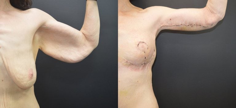56-year-old 15 days after brachioplasty and breast lift left