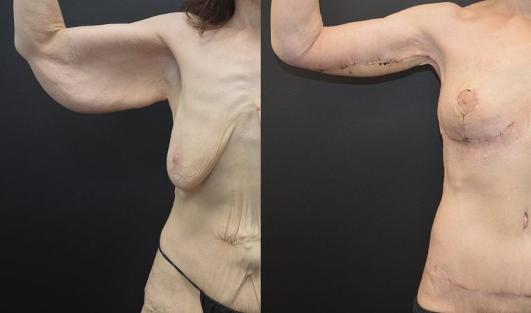 56-year-old 15 days after brachioplasty and breast lift right