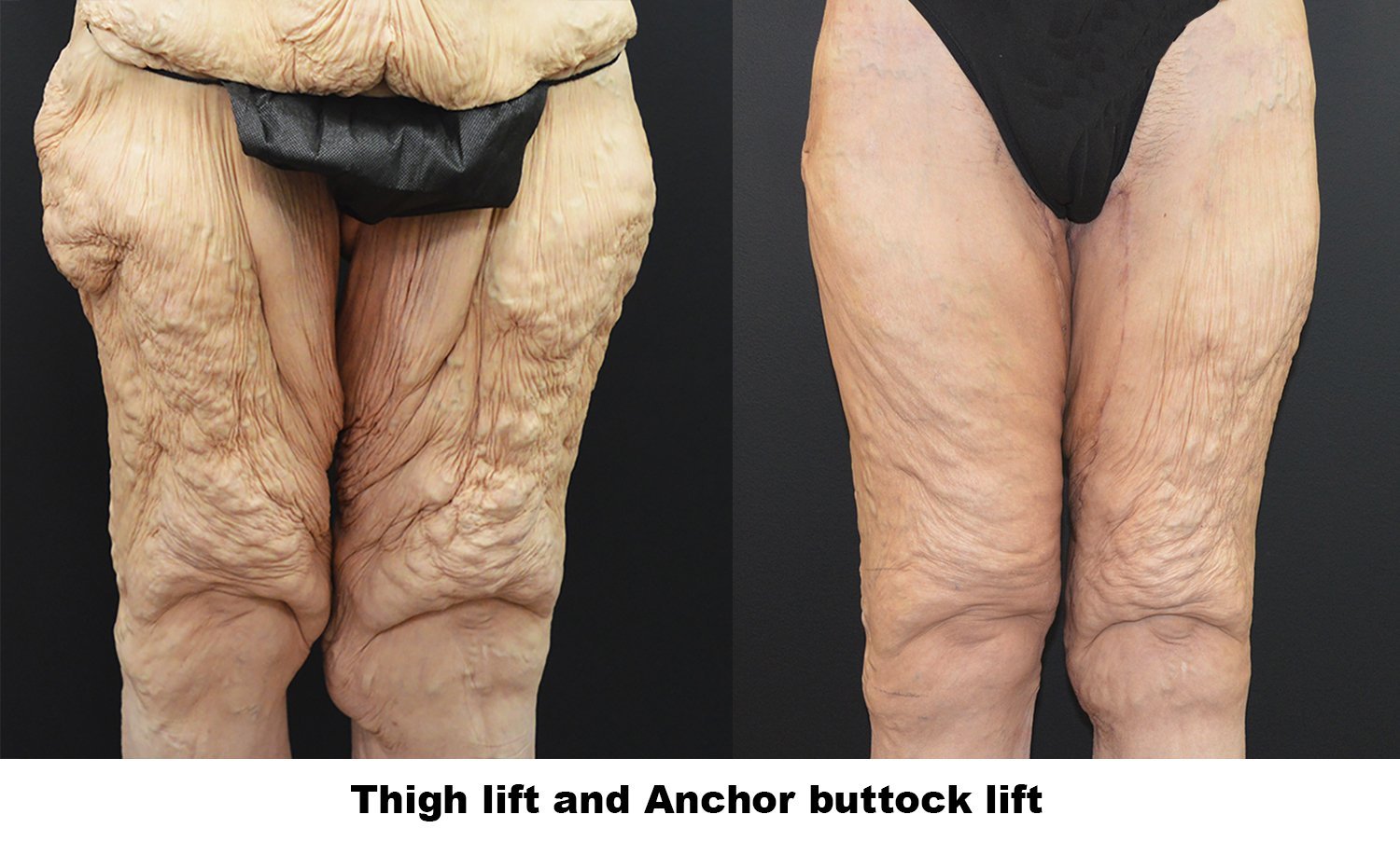 Before and after thigh lift surgery — left thigh at 3 months, right at 6 weeks, Kirwan Plastic Surgery