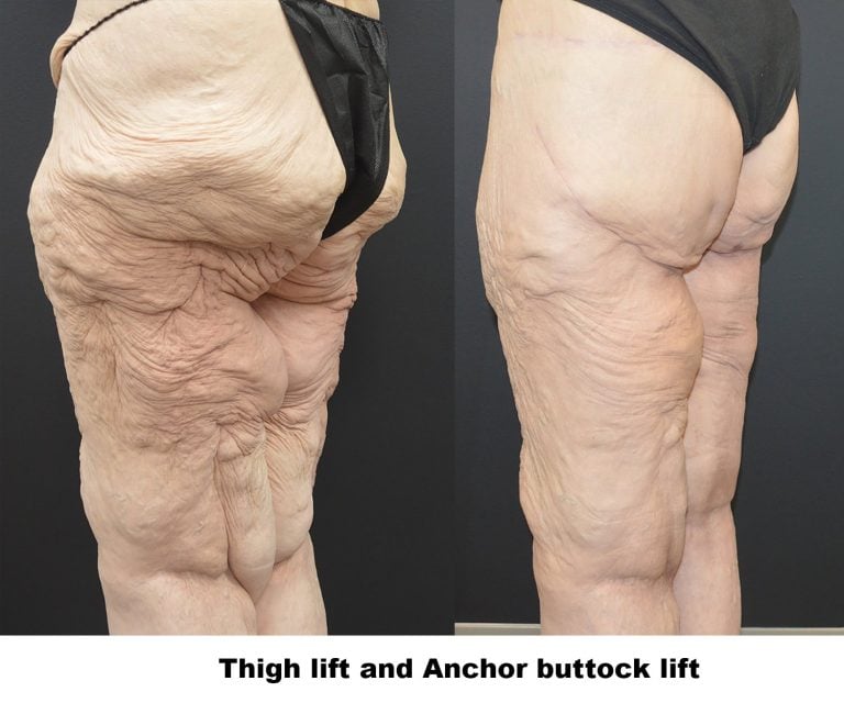 56-year-old-3-months-after-left-thigh-lift-and-6-weeks-after-right-thigh-lift-left-oblique-caption