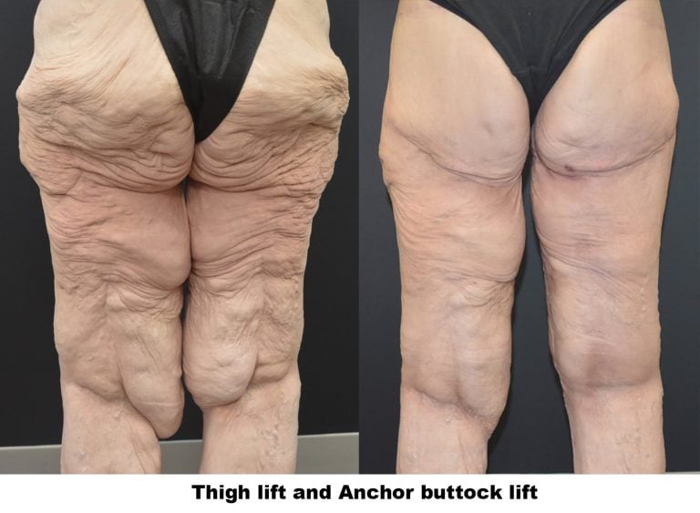 56-year-old-3-months-after-left-thigh-lift-and-6-weeks-after-right-thigh-lift-posterior-caption