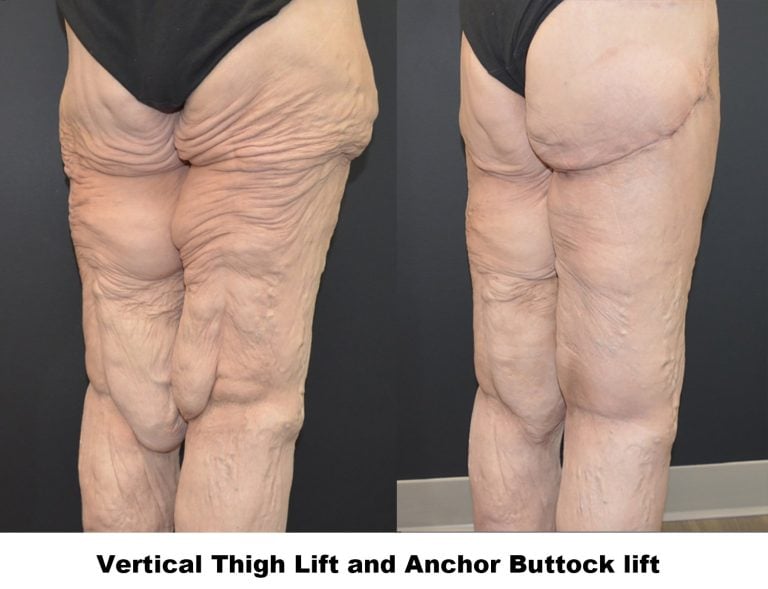 56-year-old-3-months-after-left-thigh-lift-and-6-weeks-after-right-thigh-lift-right-oblique-caption