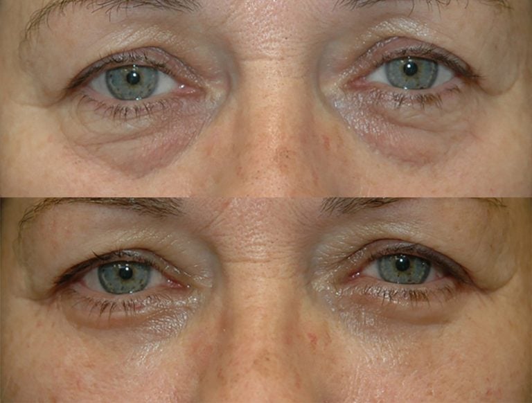 A 56-year-old patient, one month after blepharoplasty surgery with SOOF (suborbicularis oculi fat) suspension