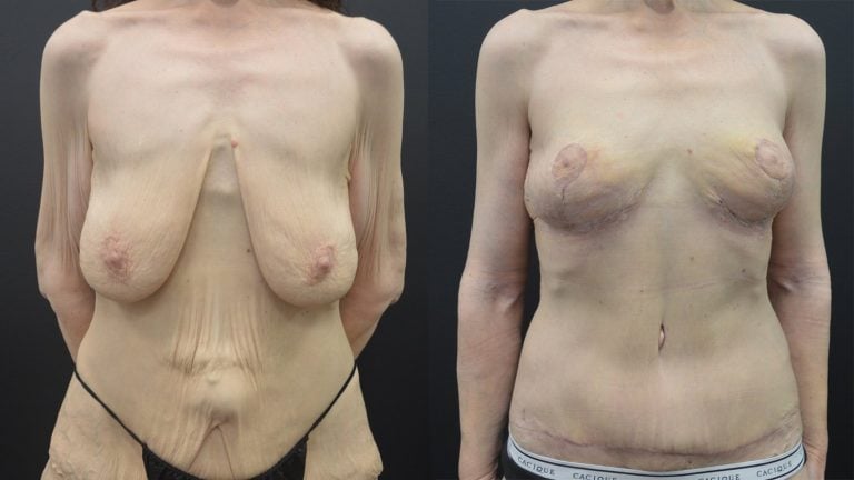 56-year-old 5 weeks after brachioplasty and breast lift, 4 months after abdominoplasty and Lower Body Lift, front.