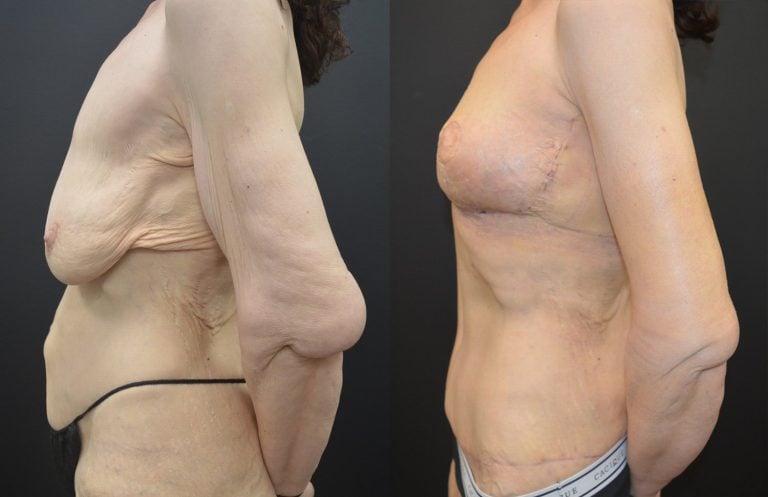 56-year-old 5 weeks after brachioplasty and breast lift, 4 months after abdominoplasty and Lower Body Lift, side view.