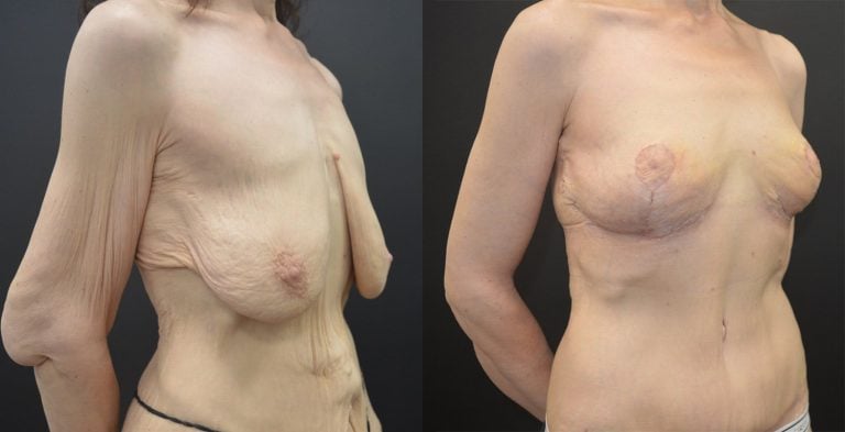 56-year-old 5 weeks after brachioplasty and breast lift, 4 months after abdominoplasty and Lower Body Lift,, right oblique.
