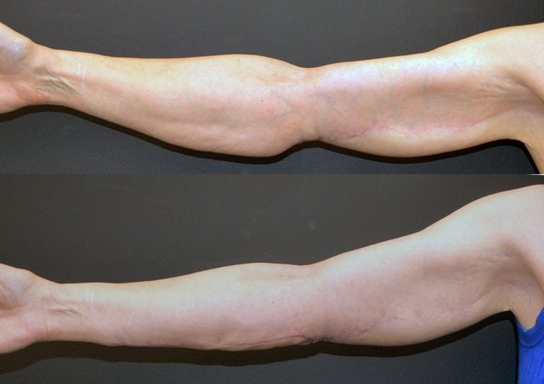 56-year-old-6-weeks-after-right-forearmplasty-10-months-after-brachioplasty-anterior-abducted-90-degrees