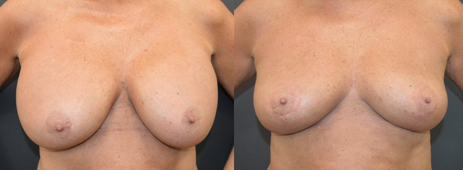 Before and after bilateral breast implant removal with auto-augmentation at 8 weeks, Kirwan Plastic Surgery