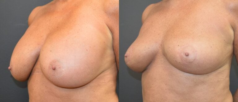 56-year-old-bilateral-breast-implant-removal-and-breast-auto-augmentation-8-weeks-left-oblique-1