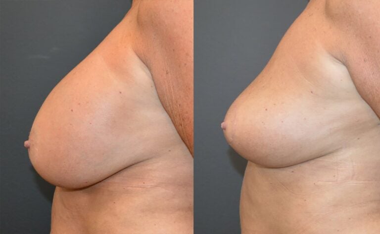 56-year-old-bilateral-breast-implant-removal-and-breast-auto-augmentation-8-weeks-left-side-1