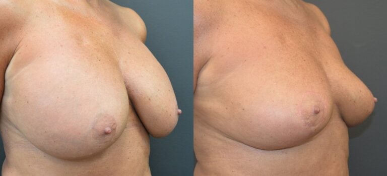 56-year-old-bilateral-breast-implant-removal-and-breast-auto-augmentation-8-weeks-right-oblique-1
