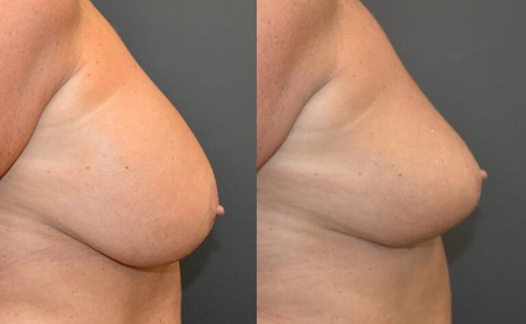 56-year-old-bilateral-breast-implant-removal-and-breast-auto-augmentation-8-weeks-right-side-1
