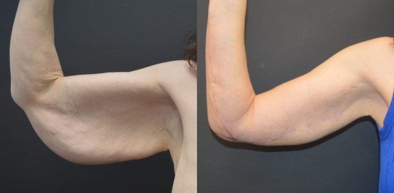 56-year-old-brachioplasty-11-months-after-brachioplasty-and-5-weeks-after-forearm-lift-right-arm-front