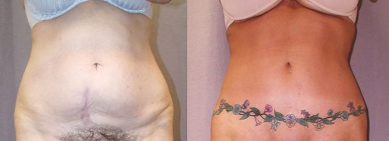56-year-old-CROPPED-lower-body-lift-abdominoplasty-28-months-front