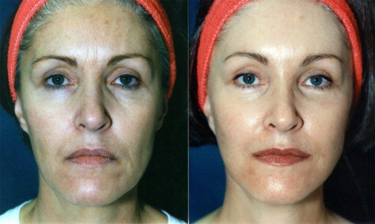 56-year-old-facelift-browlift-12-months