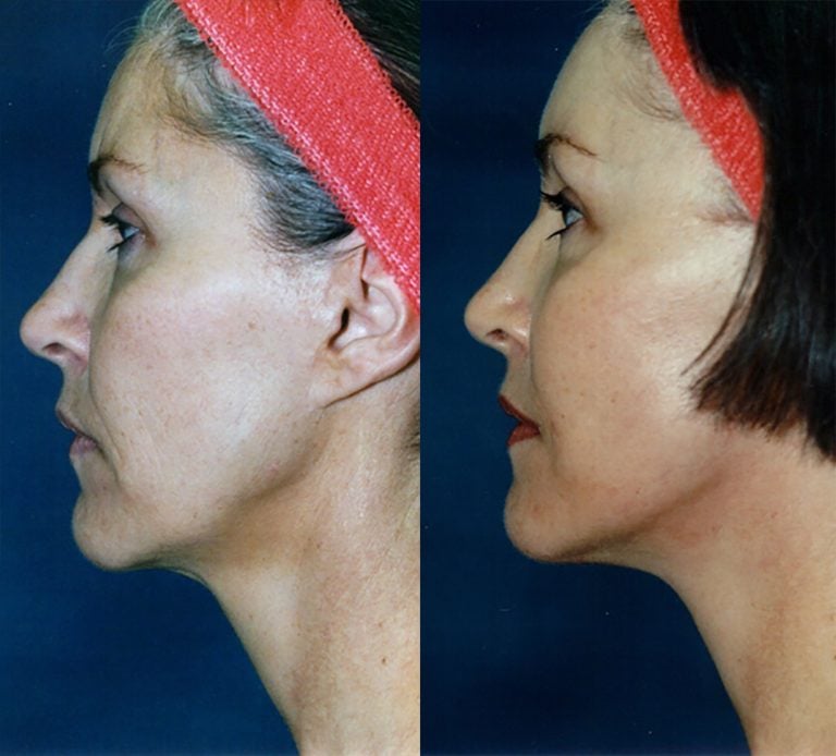 56 year old facelift browlift 12 months side