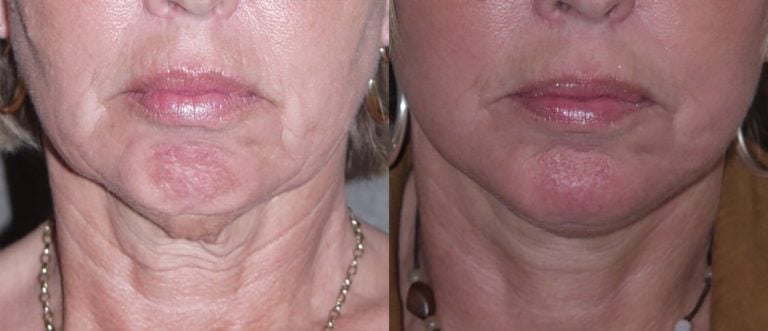 56-year-old-facelift-chin-augmentation-15-months-after-surgery-front-view