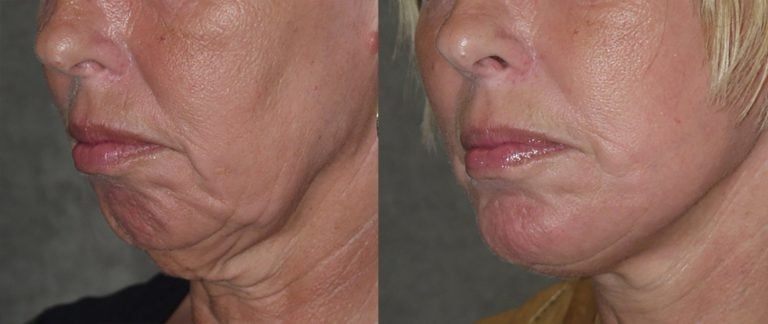 56-year-old-facelift-chin-augmentation-15-months-after-surgery-oblique-view