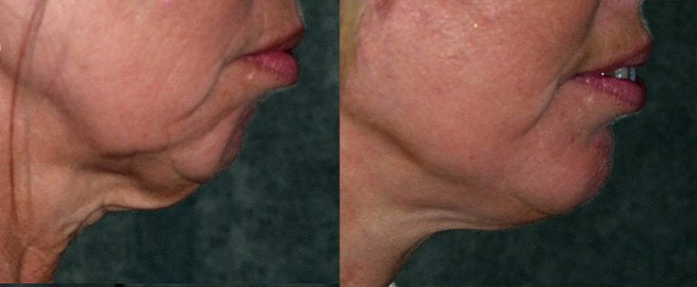 56 year old facelift chin augmentation 15 months after surgery side view