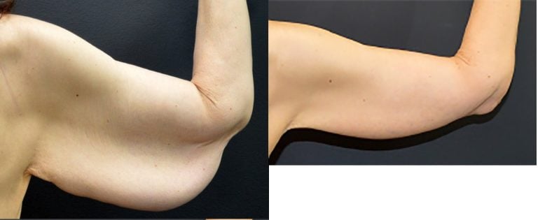 56-year-old-female-before-and-after-brachioplasty-9-months-right-posterior