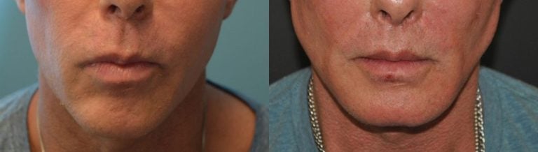 56-year-old male, square chin implant 3 years after surgery, front view.
