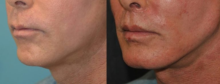 56-yearold-Male-square-chin-implant-3-years-after-surgery-oblique